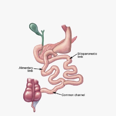 biliopancreatic