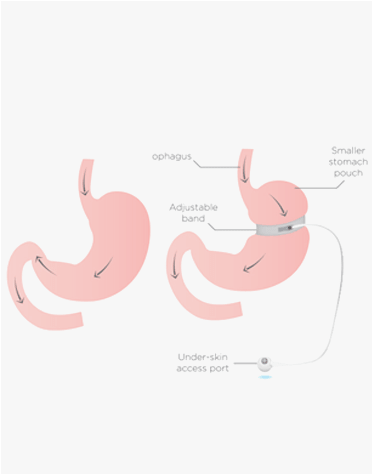 gastric-pass