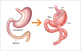 gastric-bybass